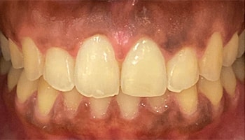 54429 Invisalign Cosmetic Bonding C1 after featured