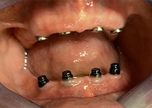 implant supported dentures 1