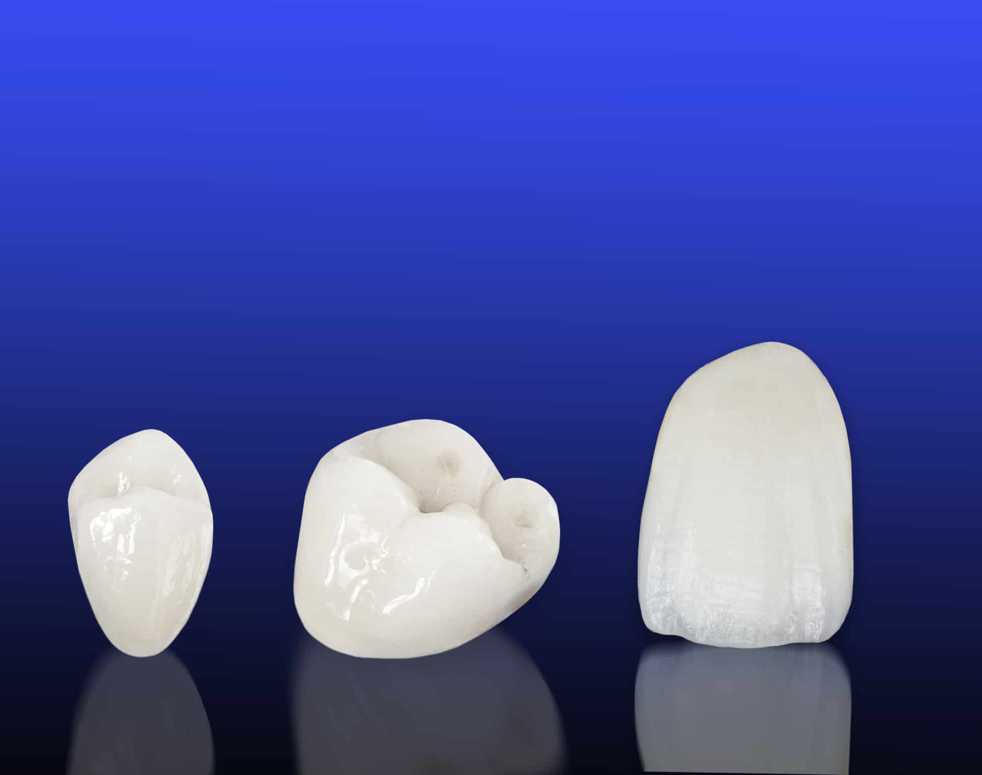 porcelain crowns example 1