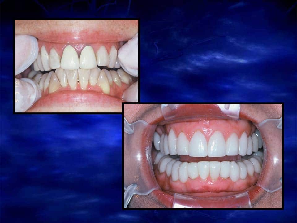 Dental Crown Before & After Montreal