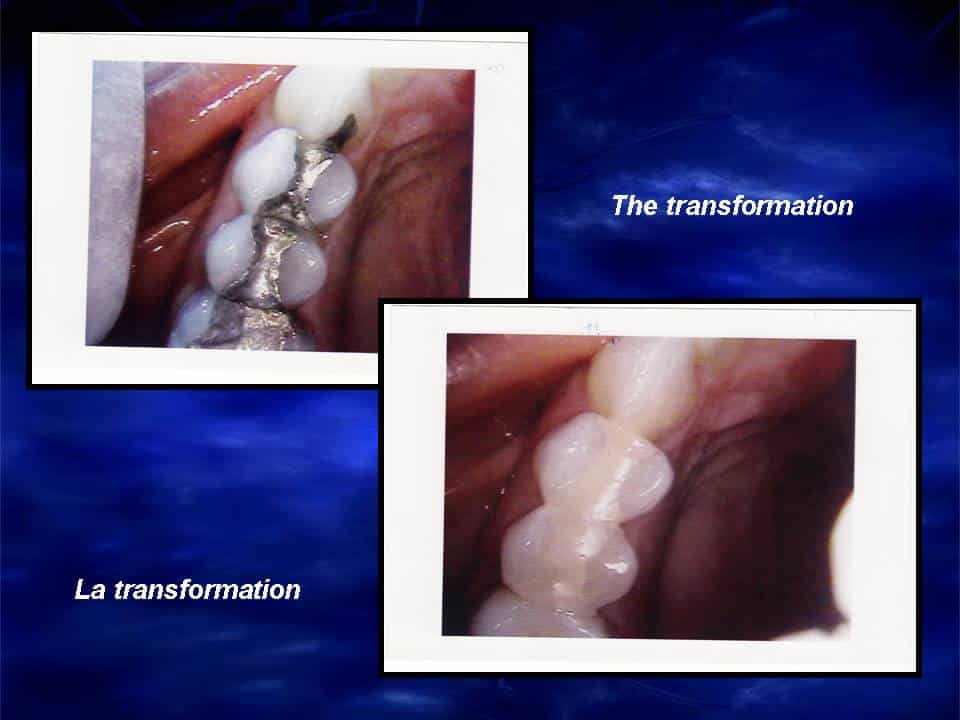 White Fillings Montreal | Dental Fillings White Fillings Montreal | Dental Fillings