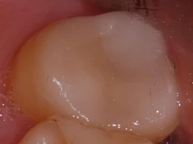 dental onlay after