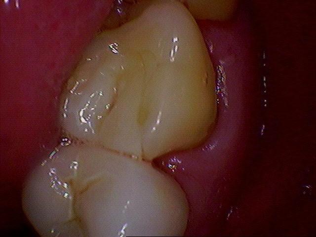 dental onlay before 