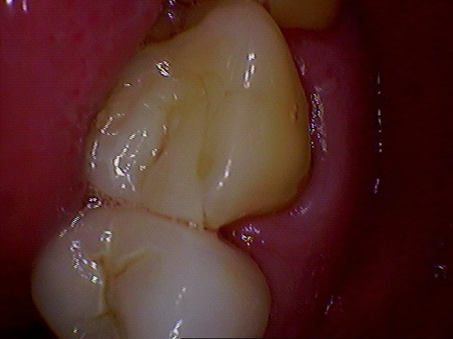 dental onlay before dental onlay before