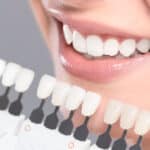Teeth Whitening Montréal Québec