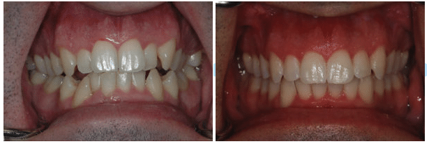 Invisalign Before & After Montreal