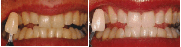 Teeth Whitening Before & After Montreal