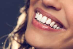 Zoom Teeth Whitening Montreal