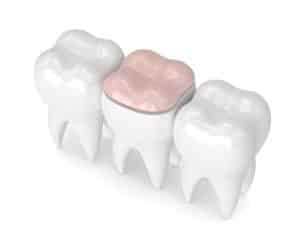 dental onlays montreal