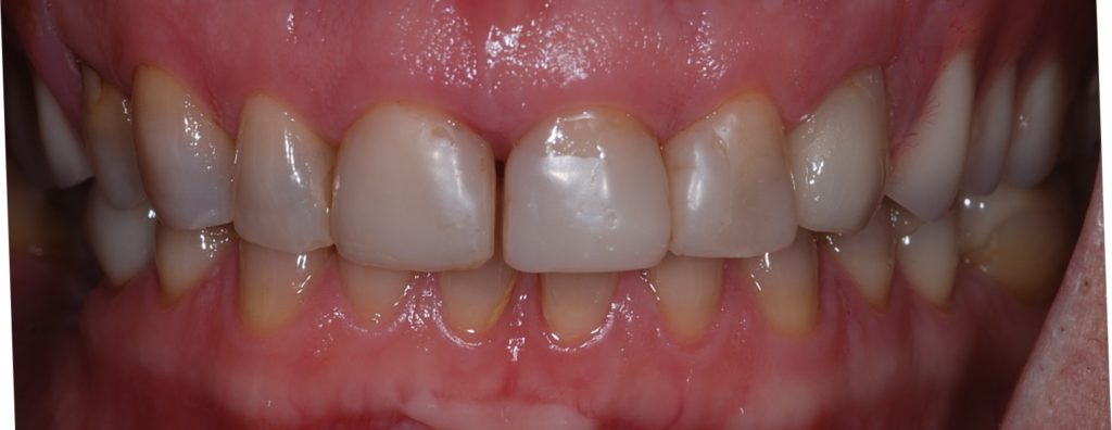 Implant Supported Dentures Montreal