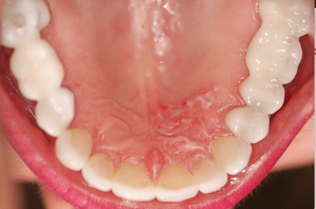 Full upper arch restoration with porcelain veneers on the front teeth and 2 bridges on the side.