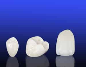 Dental Crowns Montreal | Porcelain Crowns Downtown Montreal