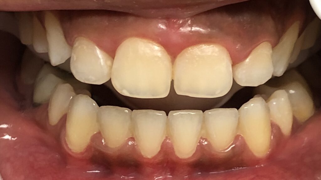 <strong>Patient appearance pre treatment. Her front teeth are too short.</strong>