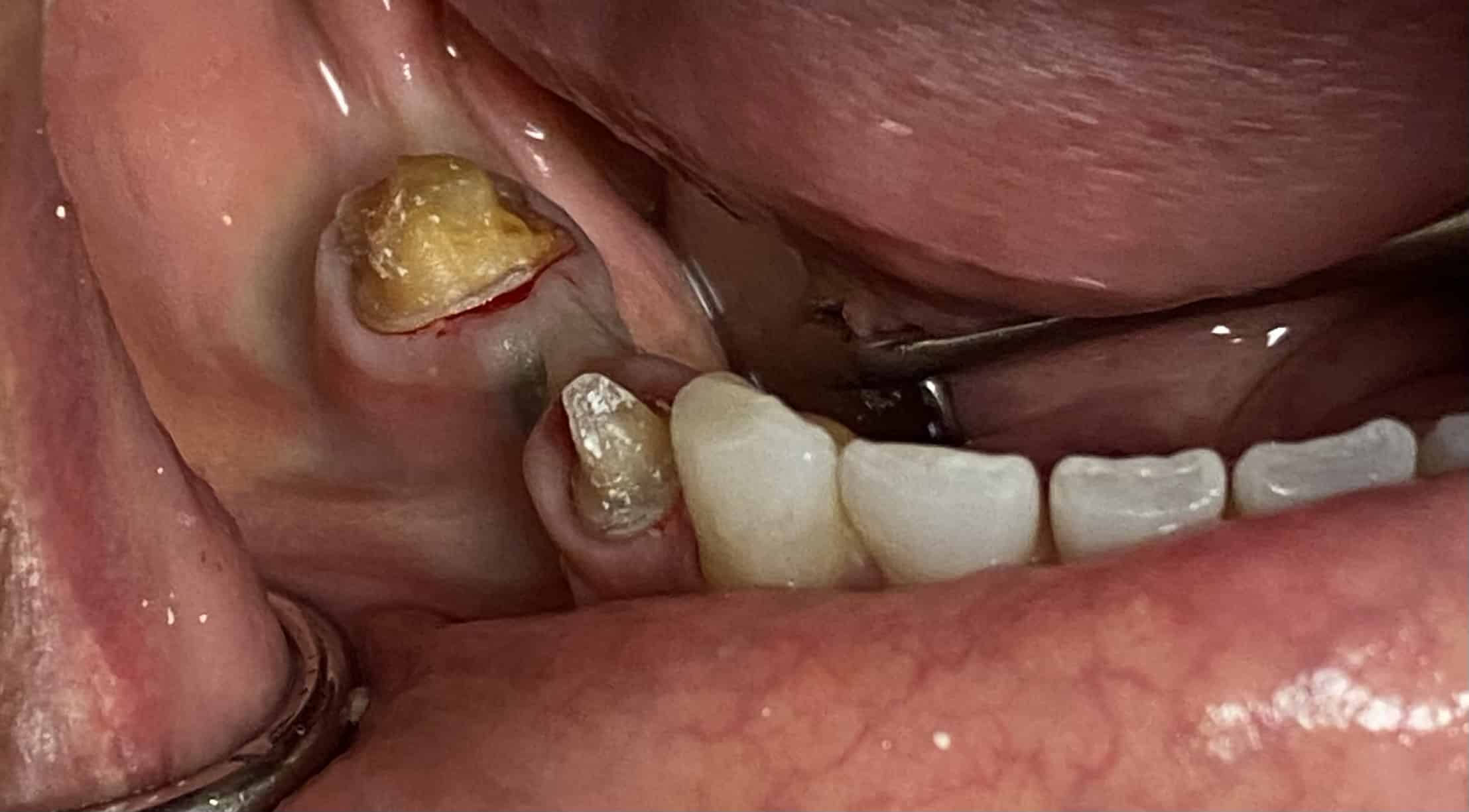 Dental Bridges Montreal Dental Bridges Montreal