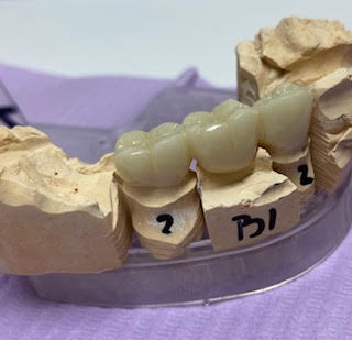 Dental Bridges Montreal Dental Bridges Montreal
