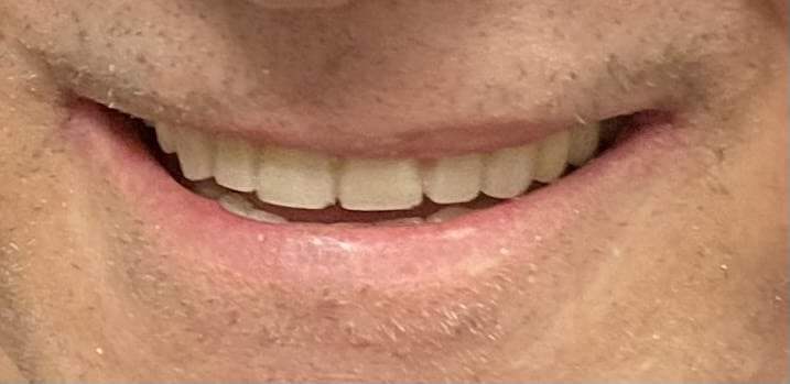 Smile with Temporaries