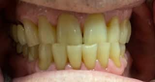 Before Treatment