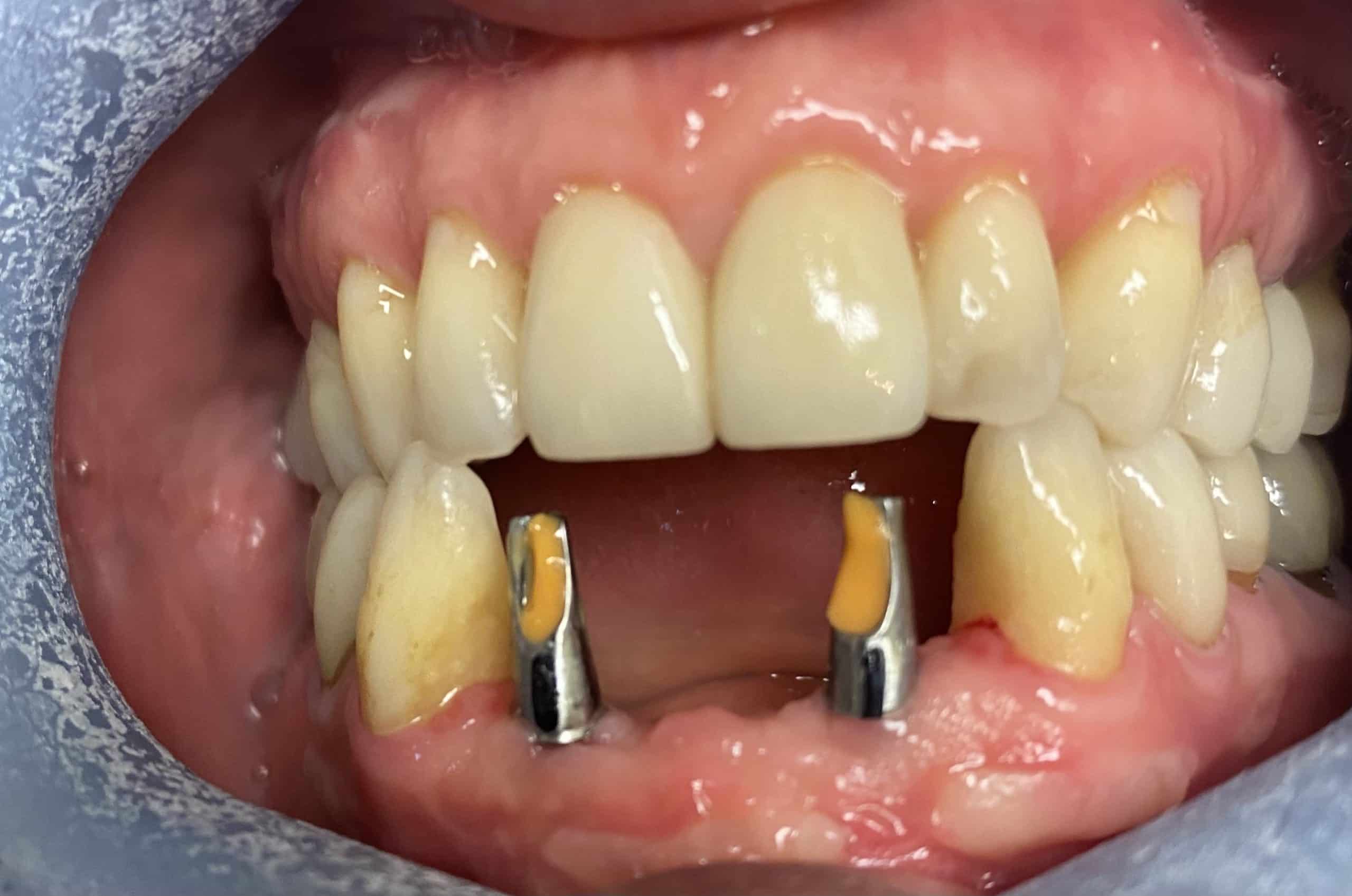 Abutments which are sitting on the Implant.