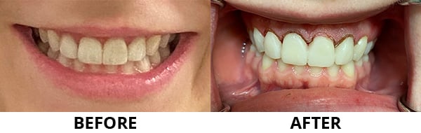 Smile Makeover Montreal