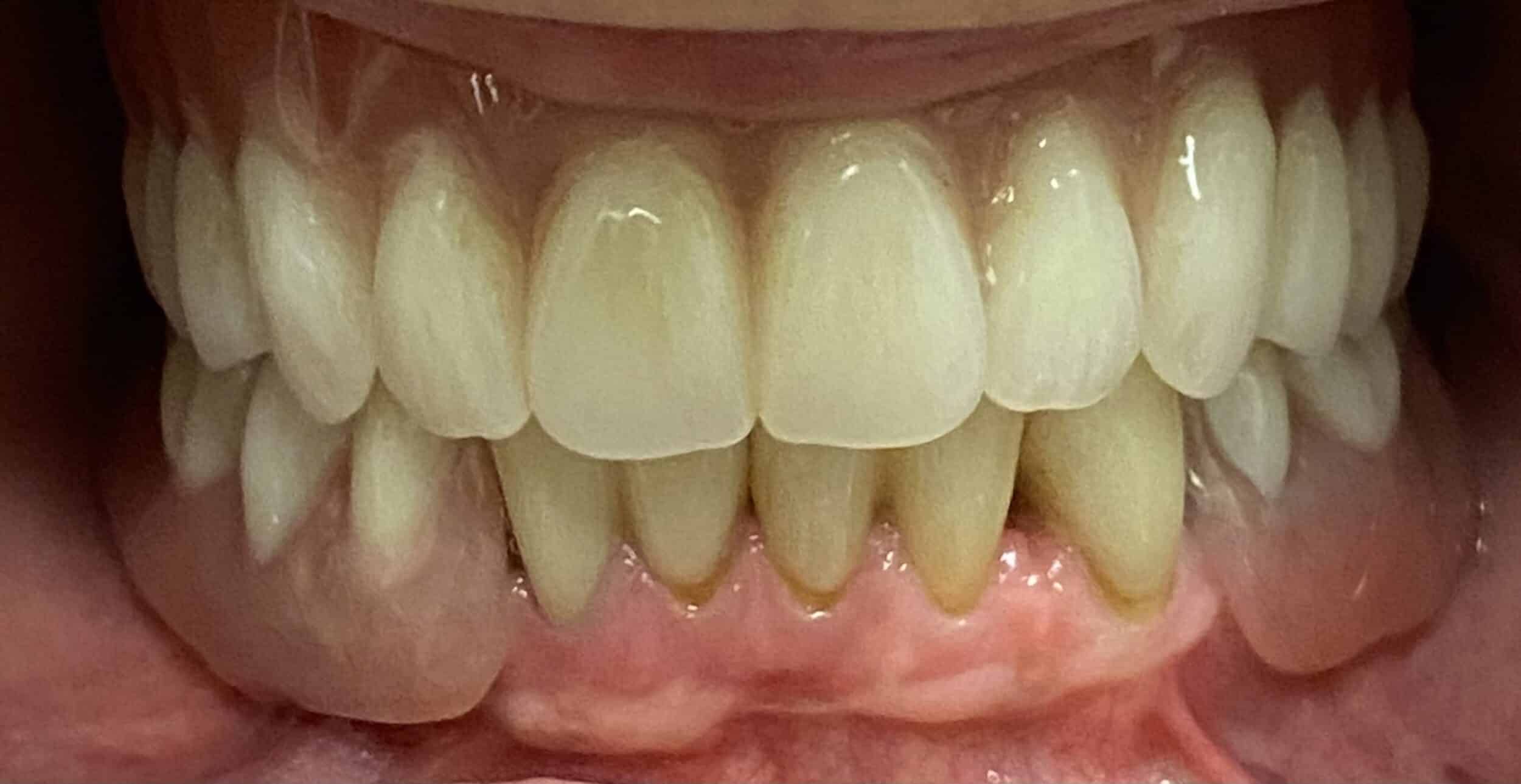Implant Supported Partial Denture in Place. scaled