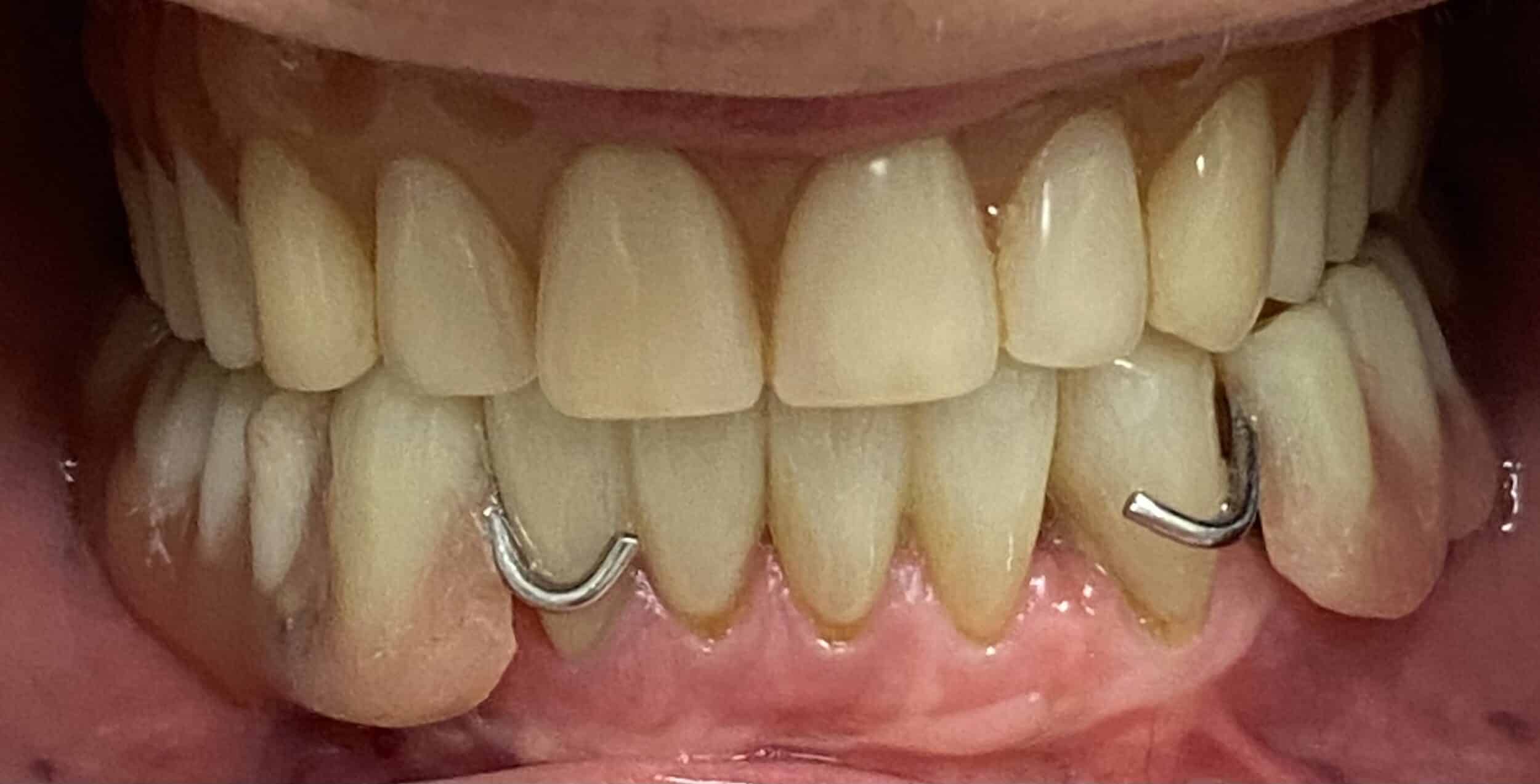 Initial Lower Partial Denture with Clasp