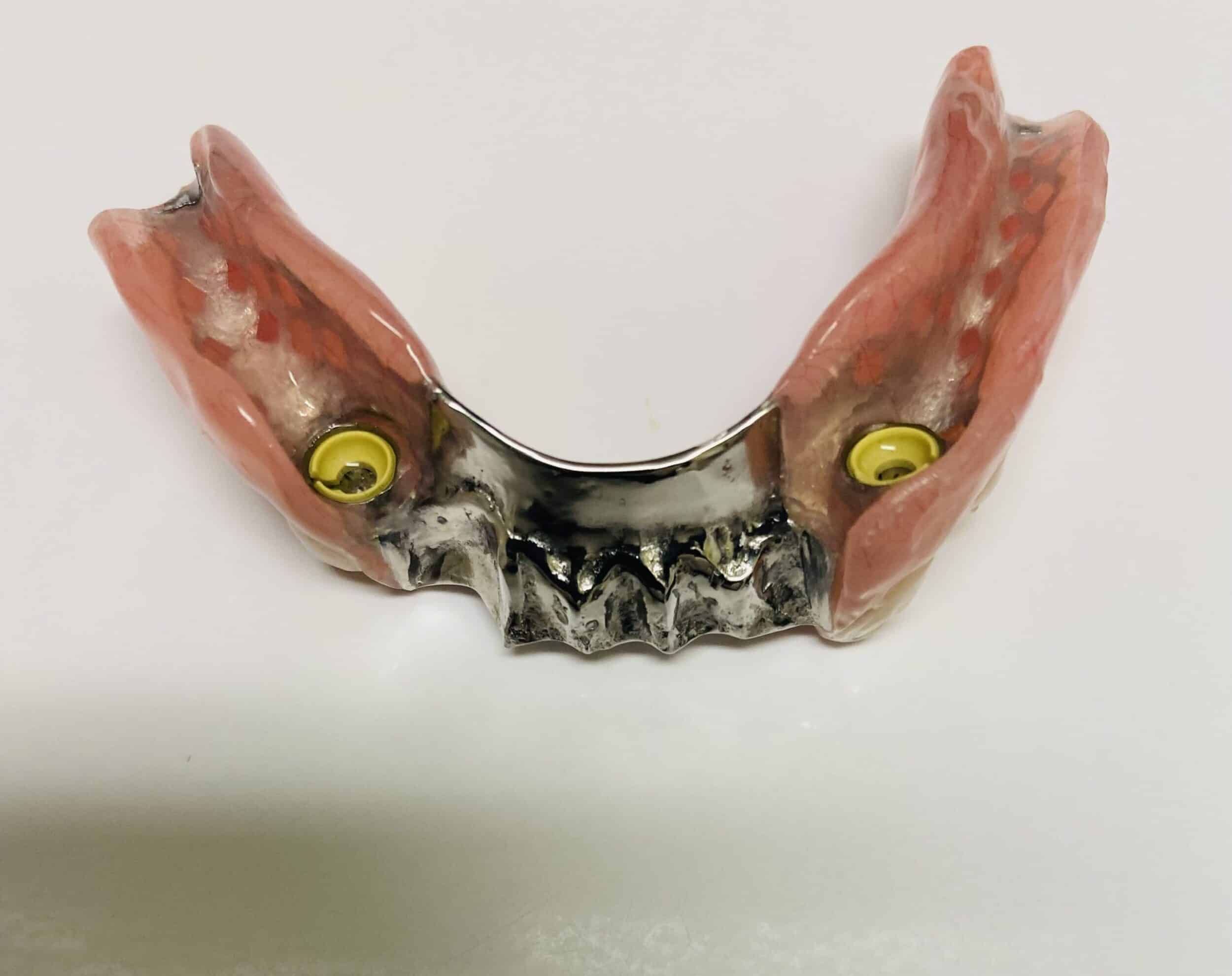 Undersurface of Implant Supported Partial Denture scaled