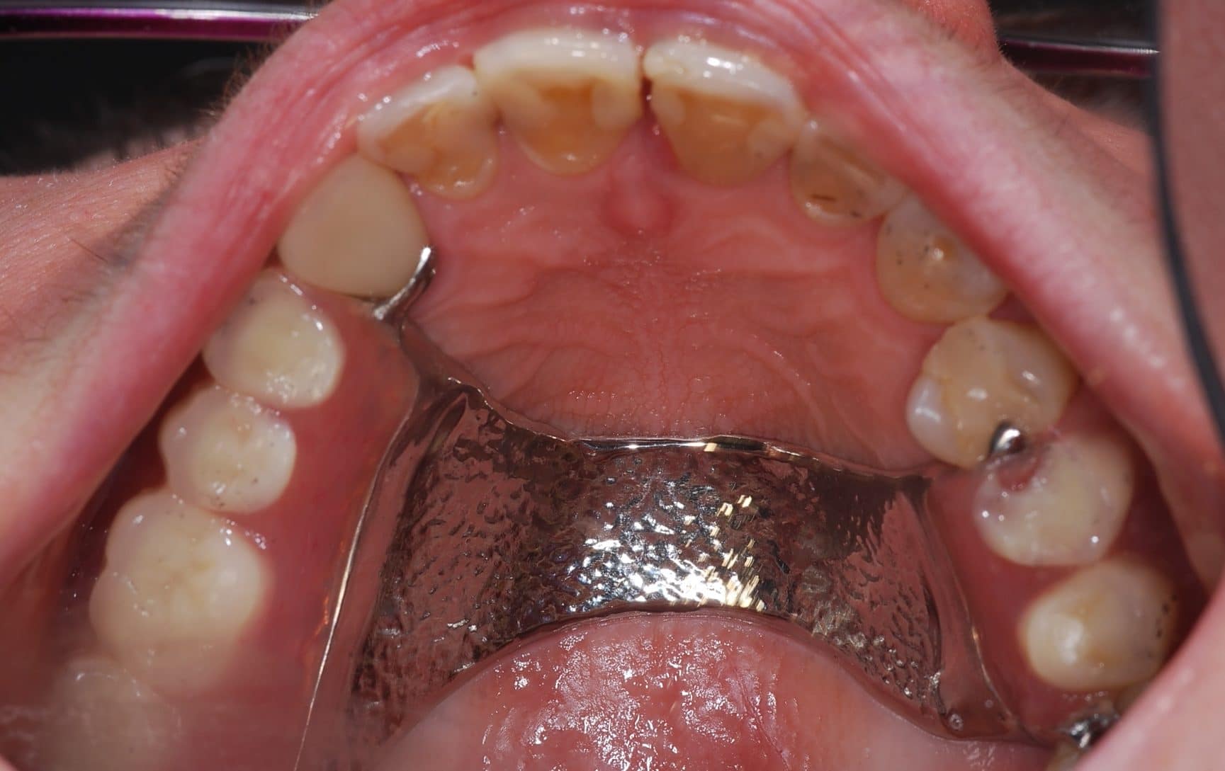 Implant Supported Dentures Montreal QC - Overdentures QC