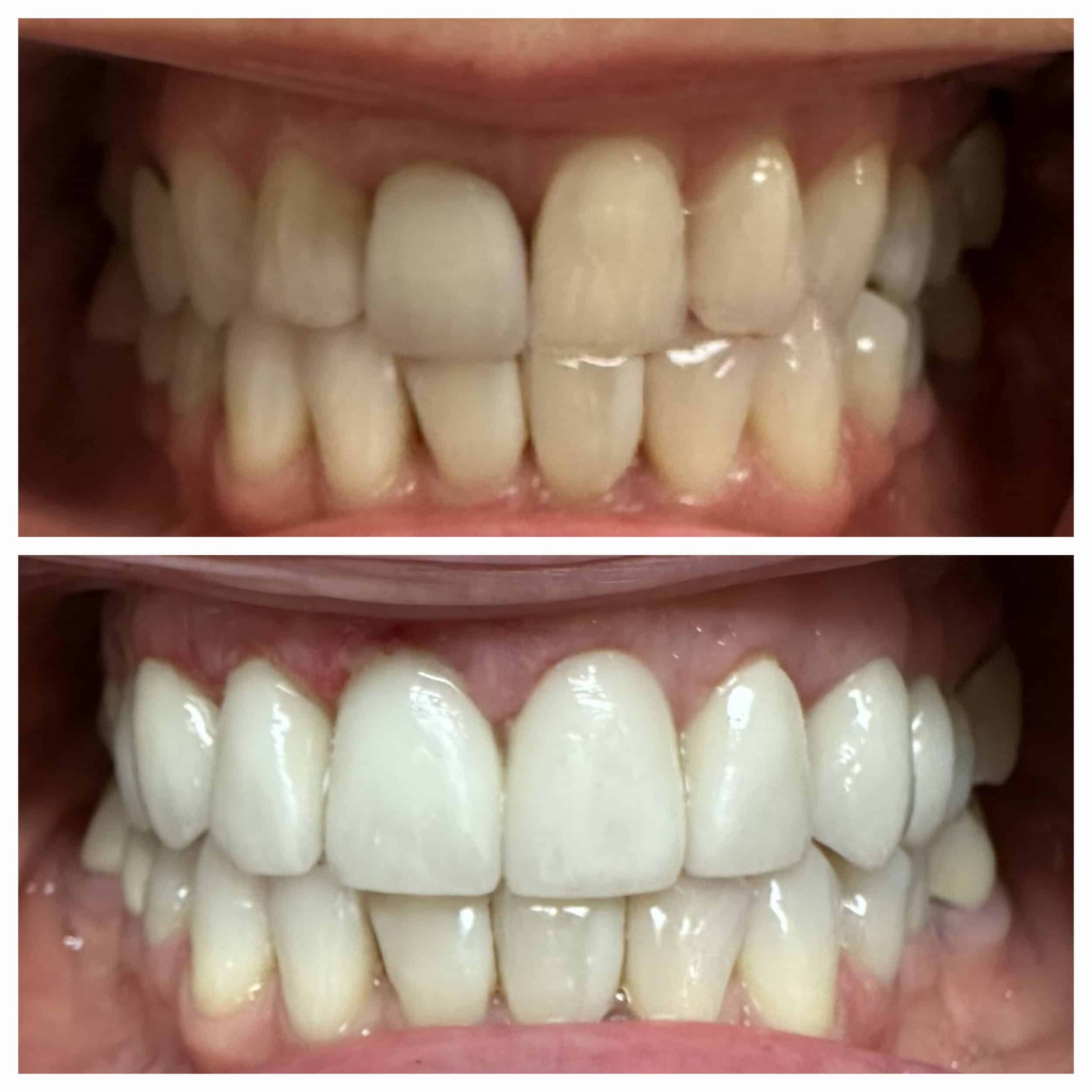 Dental Veneers Montreal QC Porcelain Veneers