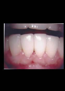 Resin Bonded Veneers (Smile Makeovers)