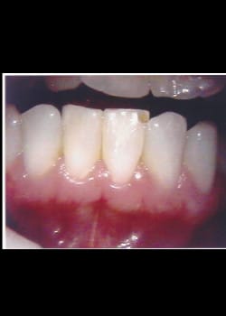 Resin Bonded Veneers (Smile Makeovers)