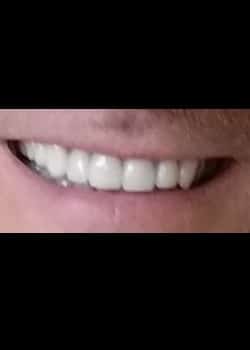 Veneers (Smile Makeovers)