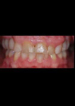 Veneers (Smile Makeovers)